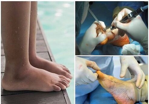 Small -invasive surgical treatment