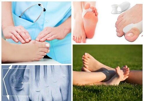 Treatment of valgus deformation