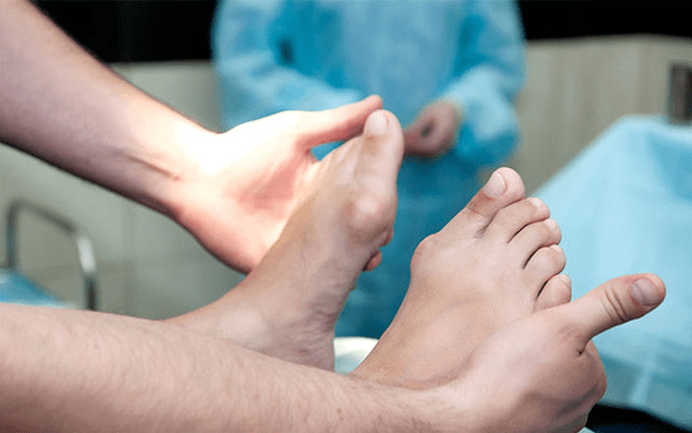 Valgus deformation of the foot